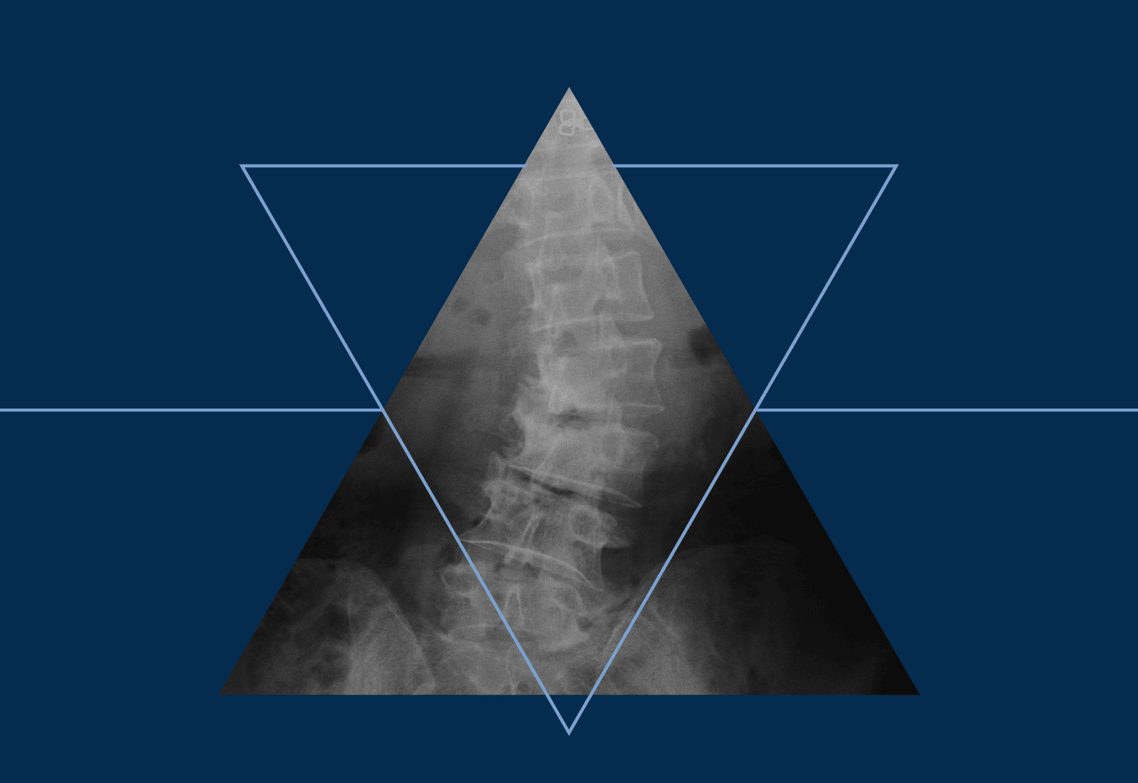 spine xray inside a triangle